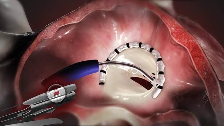 Edwards Lifesciences heart valve medical device.
